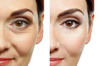 Blepharoplastie en Tunisie