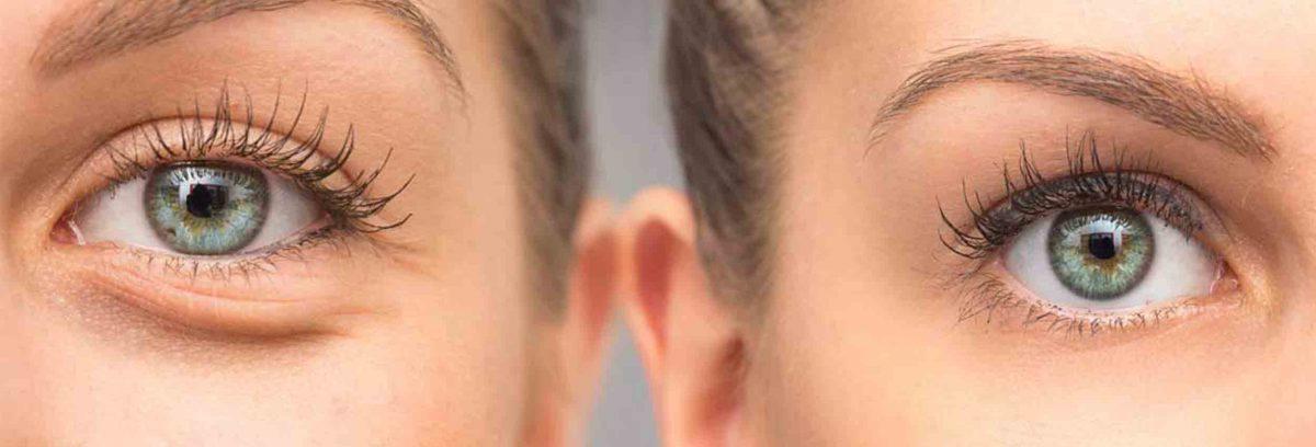 Blepharoplastie-1200x408.jpg